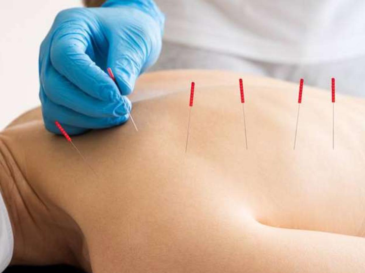 Acupuncture