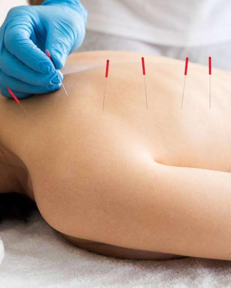 Acupuncture